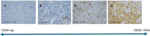 Tumor tissue sections from four distinct cases at 400× magnification, representing the spectrum of CD30 expression using the CD30 (Ber-H2) reagent. A: absence of CD30 expression; B: 10% CD30 expression; C: 40% CD30 expression; D: 80% CD30 expression.