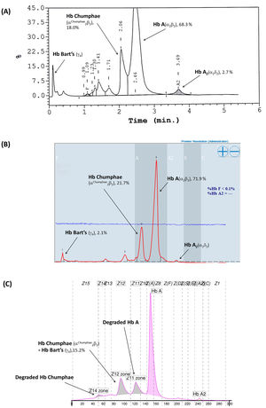 Hemoglobin (Hb) analysis results obtained using three different automated Hb analyzers. (A) Hb-chromatogram profile on the HPLC-Variant II system. (B) Hb-chromatogram profile on the HPLC-Premier Resolution system. (C) Hb-electropherogram pattern by capillary electrophoresis.