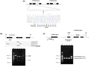 Mutation identification using DNA sequencing, polymerase chain reaction (PCR)-restriction fragment length polymorphism, and allele-specific PCR. (A) The sequencing profile of the α2-globin gene shows antisense strand sequences in codon 10, where the GTC–GAC mutation causes hemoglobin (Hb) Chumphae. (B) GTC-GAC mutation identification using BstPAI digestion of the PCR product. M represents the 100-bp DNA ladder markers. Lane 1 displays undigested amplified DNA for gel electrophoresis. Lanes 2–5 show digested amplified DNA samples. Lanes 2–4 contain BstPAI-digested amplified DNA from non-mutated samples, showing 818- and 267-base pair (bp) digested fragments. Specifically, lane 4 also has a 1085-bp undigested fragment, indicating the presence of Hb Chumphae. (C) Hb Chumphae mutation is identified using an allele-specific PCR assay. Primers SP60 and C3 amplify an 834-bp fragment specific to Hb Chumphae, whereas primers γ4 and γ5 amplify a 578-bp internal control band. M represents the 100-bp DNA ladder markers. Lane 1: negative DNA control; lanes 2 and 3: normal DNA samples; lane 4: DNA of the patient with Hb Chumphae co-inherited with α0-thalassemia.