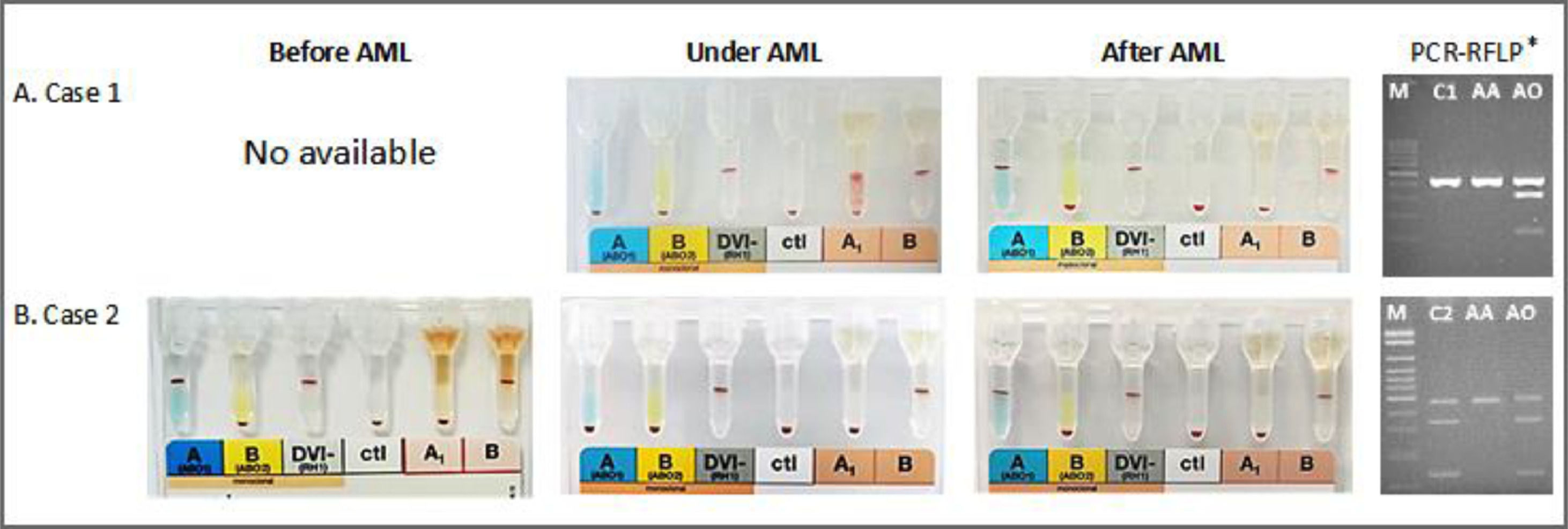 ABO discrepancy resolution in two patients with acute myeloid leukemia ...