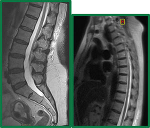 Dorsal and lumbosacral spine MRI (T2 sequences). No findings to justify the clinical picture.