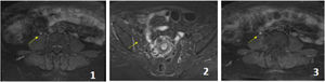 Pelvic MRI with contrast, T1 sequences with contrast and STIR. The femoral nerve (yellow arrows) presents without signs of extrinsic compression. The signal is slightly increased in STIR sequence both in its abdominal path next to the psoas (1) and in its pelvic sector next to the iliac psoas (2). It presents enhancement after intravenous contrast administration, which is asymmetric with its contralateral counterpart (3).