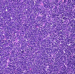 Haematoxylin-Eosin (HE) staining of excised tissue showing Atypical lymphoid cells with fine chromatin and convoluted nuclear contours. The cells are in B-cell Lymphoblastic lymphoma are indistinguishable from those seen in lymphoblastic leukemia.