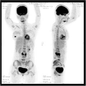 Initial PET-CT scan showing FDG uptake at the L3 vertebral body with paraspinal extension.