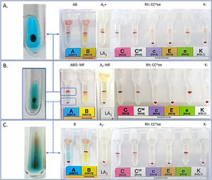 ABO, Rh, and Kell phenotyping results in Column Agglutination Technology of the separated (A and C) and non-separated (B) RBCs from the Mixed Field.
