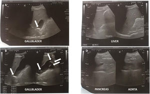 Abdominal ultrasound performed on the 5th day of symptoms. (A and B) Several mobile calculi (from 0.9 to 1.8 cm) were identified inside the gallbladder. White arrows point the calculi. (C) Both liver echotexture and intra- and extra-hepatic canaliculi were normal. (D) Pancreas echotexture was normal.