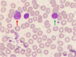 Cytological findings of the patient's blood smear. Two morphologically different populations of lymphoid cells (green and red arrows) are identified (Leishman stain; x 100 objective).