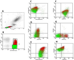 Flow cytometry findings of the patient's blood. A: Flow cytometry's physical parameters (FSC and SCC) show two different populations of lymphoid cells: ‘green’ (FSCvery low, SSCvery low) and ‘red’ (FSCintermediate, low SSClow). B: ‘Green’ B-cells: CD5−/CD19+ and ‘red’ B-cells: CD5+/CD19+, C. Kappa light-chain restriction of ‘green’ (kappalow) and ‘red’ (kappamoderate) B-cells. D, E, F, G, H: ‘Green’ B-cells were CD11c+, CD20moderate, CD22low, CD23−, CD34−, CD43−, CD58partial, CD79blow, CD200moderate, and HLA-DR+; ‘red’ B-cells were CD11c+, CD20moderate, CD22low, CD23+, CD34−, CD43+, CD58+, CD79blow, CD200bright, and HLA-DR+.