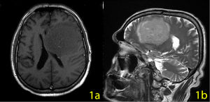 First presentation, 70×65×62 mm-sized lesion in the left frontal lobe.