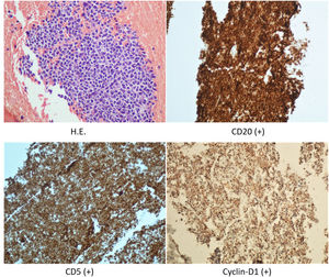 Stereotactic biopsy, immunohistochemistry analysis demonstrated that CD20, CD5, and Cyclin-D1 were positive.