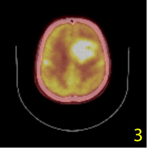 PET-CT imaging.