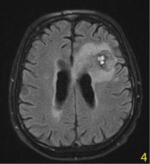 8th day of the MATRix regimen; in the cranial MRI, the mass was reduced to 40×34×20 mm.