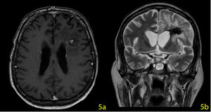 Cranial MRI on the 30th day, the mass was reduced to 36×25×17 mm.