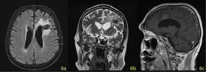 Cranial MRI on the 45th day, the mass was reduced to 23×22.5×15 mm.