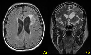 Cranial MRI on the 210th day, the mass disappeared leaving a 20×15 mm malasic area with peripheral gliosis.