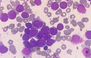Bone marrow aspirate smear showing infiltration by morphologically undifferentiated blasts. May-Grumwald-Giemsa, 1000x.