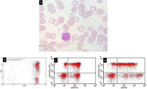 Cytological and flow cytometry findings of the patient's blood. (A) The blood smear shows the cerebriform aspect of the nucleus of the lymphoid cell (Leishman stain; x100 objective). (B) Dot-plot showing the double positive (CD4 and CD8) T-cells. (C) Dot-plot showing the CD4+/TCL1+ T-cells. (D) Dot-plot showing the CD8+/TCL1+ T-cells.