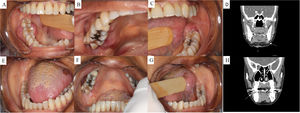 (A and B) Initial clinical aspects of intraoral lesions, presence of nodular lesions in the inserted gums of the right side in the posterior, superior and inferior regions on the buccal vestibule and lingual. (C) Initial clinical aspect of intraoral lesion, presence of a nodular lesion in the inserted gums of the left side in the posterior on the buccal. (E–G) Clinical aspects of the resolution of intraoral lesions after systemic therapy. (D and H) computed tomography, soft tissue window of the cervical region, coronal section, cervical linfoadenopathy on the left (D), and gingival enlargement on the right mandible.