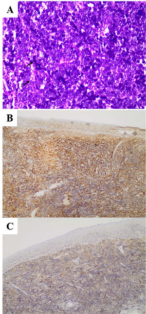 (A) Pathological assessment: H&E staining, magnification ×20, the photomicrograph shows mononuclear infiltrate with hyperchromatic cells (¹) and neoplastic cells with larger chromatin and loose nuclei (²), where you can use the small nucleoli corresponding to the centroblasts, which are the immature lymphocytes of lineage B. (B) Photomicrograph showing immunostaining for CD20. Immunohistochemistry 10×. (C) Photomicrograph showing immunostaining for CD10. Immunohistochemistry 10×.