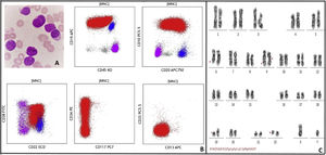 A: Peripheral blood smear at blast crisis showing many lymphoid blasts, B: Flow cytometry dot plots show B lymphoid blasts (red) expressing CD19 (bright), CD10 (bright), CD34 (variable), CD20 (variable), CD45 (variable), and negative for CD117, CD13, and CD33. Normal B cells (blue) and T cells (pink) are also seen, C: Representative karyotype of a metaphase cell showing 46,XY,t(6;9;19;22)?(q21;q34;p11,q11.2),i(9)(q10)[14]/46,XY[2].