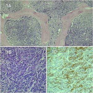 A: Scanner view of bone marrow biopsy shows infiltration by tumour cells with fibrosis. Figure1B: Tumour cells are monomorphic with vesicular chromatin and prominent nucleoli. Figure1C: Tumour cells are positive for pan-cytokeratin.
