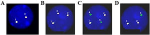 An FGFR1 (8p11) rearrangement was detected using fluorescence in situ hybridization (FISH) with Cytocell FGFR1 Break apart/Amplification probe. Analyzing 200 cells from peripheral blood showed that: A. 20% of cells are normal; B. 15% of cells have 3 signals of FGFR1; C. 25% of cells have 2 signals of FGFR1 with 2 signals lost 3’ end of FGFR1, and; D. 40% of cells have 2 signals of FGFR1 with 1 signal lost 3’ end of FGFR1.