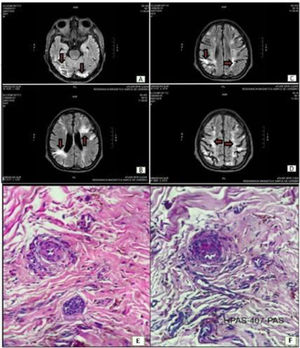 Brain MRI. Diffusion images showing hyperintense areas consistent with multiple areas of cerebral ischemia (orange arrows). A. occipital lobe. B and C. temporal lobe. periventricular level. and D. parietal cortex. E and F: Skin biopsy electron microscopy: Vascular proliferation with segmental hyalinization of the wall. PAS-positive X40.