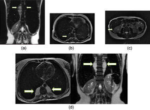 T2 fast spin echo magnetic resonance imaging (MRI) scans: A) Coronal scan of case 9, showing large soft tissue mass in the thoracic and lumbar paravertebral space (arrows); hepatosplenomegaly and marked hypo intensity of the liver and spleen, which indicates iron deposition. B) Axial scan of case 124 showing small soft tissue mass in the right thoracic paravertebral space (arrow). C) Axial scan of case 13 showing small soft tissue nodule in the hepatorenal space (arrow), presenting marked hypo intensity, indicating iron deposition. D) Axial and coronal of case 132 showing large soft tissue mass in the thoracic paravertebral space. Note the marked hypo intensity of the liver and spleen (coronal), which indicates iron deposition.