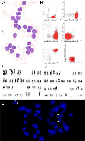 (A) Prolymphocytes in peripheral blood, Wright-Giemsa 100x (B) Flow cytometry showed strongly positive for CD3, CD8 and CD7. (C) Metaphase presenting a complex karyotype, with a der(2)t(1;2), i(8)(q10), der(9), der(14) and a marker chromosome. (D) Metaphase shows complex karyotype with a der(2)t(1;2), i(8)(q10), der(11q) inversion of chromosome 14,rob(14;15)(q10;q10), t(13;17) and three marker chromosomes. (E) FISH with the LSI IGH Dual Color, Break Apart Rearrangement Probe (Vysis) showed four signals of the IGH gene, two of them show on the same chromosome.