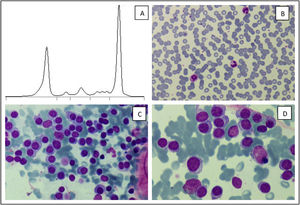 A. M peak in serum protein electrophoresis. B. Peripheral blood smear showing Rouleaux phenomenon. C, D. Bone marrow smear showing an infiltrate by atypical plasma cells with central round nucleus with coarse cytoplasm (May-Grünwald-Giemsa stain, x500 & x1000).