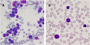 In bone marrow investigation the megakaryoblasts were enlarged with basophilic cytoplasm, distinctive pseudopods (“blebs”), and cytoplasmic projections. In addition, clusters of megakaryoblasts were detected (A). In peripheral blood the megakaryoblasts showed scant cytoplasms and dark stained nuclei (B).