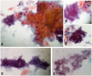 Papanicolaou stain of the cytology from case 1 material with characteristics compatible with Actinomyces infection. A and B: Actinomyces next to a grouping of reactive keratinized squamous cells. A: 40x. B: 100x in immersion. C: Actinomyces in "arachnoid" presentation. 100x in immersion. D: Actinomyces in "rat's tail" and "granules of sulfur" presentations. 100x in immersion. E: Actinomyces colonies filaments. 100x in immersion.