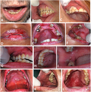 Intraoral aspect of oral Actinomycosis lesions. A and B: Case 1, with erythema and ulcers with whitish yellow detachable pseudomembrane on the marginal gingiva of maxillary and mandibular teeth C: Case 2, with necrotic appearance in marginal gingiva of 1st quadrant teeth D, E and F: Case 3, with erythema in the upper alveolar ridge, and ulcers on both lips, hard palate and left cheek mucosa G, H and I: Case 4, with coalescing ulcers on the hard palate, upper and lower right gingival ridges. J: Case 5, ulcers with an erythematous halo on the hard palate. K: Case 6, with an ulcer on the right cheek mucosa. L: Case 7, with ulcers with erythema on the hard and soft palate.