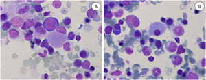 A & B. Bone marrow smear (MGGx1000). Pseudogaucher cells: big cells with large cytoplasm with onion layers appearance and eccentric nuclei.