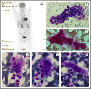 A: PET image showing supradiaphragmatic and infradiaphragmatic hypermetabolic lymph nodes and heterogeneous captation in bone. B: Bone marrow aspirate smear showing aggregates of medium-sized cells with scant and agranullar cytoplasm and nucleus with lax chromatin (May-Grünwald Giemsa x500). C. Cluster of metastatic cells PAS positive in bone marrow (Periodic Acid-Schiff staining x500). D-F: Different osteoclasts in bone marrow (May-Grünwald Giemsa x1000).