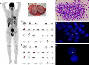(A) PET-CT shows abnormal testicular uptake (maxim SUV: 10), (B): Significant enlargement of the right testicle (after orchiectomy), (C) Testicle imprint demonstrating high concentration of abnormal plasma cells (Leishman, x 1000), (D) Karyotype of testicular plasma cells showing complex clone: 47,XY,+der(1;6)(q10;p10),del(2)(p13p11.2),der(6)t(6;8)(q21;q22),−8,t(11;14)(q13;q32),del(12)(p13p11.2),del(13)(q12q34),+15,add(22)(p11.2)[20] (GTW banding), (E) Interphase fluorescence in situ hybridization (iFISH) study in testicular plasma cells with IGH::CCND1 dual color, dual fusion translocation probe (Metasystems, Germany) showing two yellow, one green and one red signals suggestive of IGH::CCND1 fusion, (F) Karyotype of bone marrow cells showing complex clone with deletion 17p: 47,XY,+der(1;6)(q10;p10),del(2)(p13p11.2),der(6)t(6;8)(q21;q22),−8,t(11;14)(q13;q32),del(12)(p13p11.2),del(13)(q12q34),+15,del(17)(p11.2),add(22)(p11.2)[7]/46,XY[13], (G) iFISH in CD138 positive cells study with TP53/17cen dual color, deletion probe (Metasystems, Germany) showing two green and one red signals suggestive of deletion TP53.