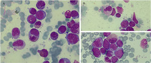 Bone marrow smear showing infiltration by blasts (all figures May-Grünwald Giemsa staining; magnification: x1000). A: Phagocytosis of an eosinophil by a blast cell (*) and eosinophils with coarse basophilic granulation. B: Neutrophil faggot cell. C. Blast cell with monocytic appearance with bundles of Auer rods (*).