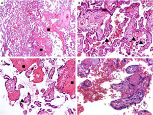 Sample images of placental histopathology in sickle cell disease patients. A. A panoramic view of a pre-term sickle cell disease placenta with mature term villi. HE: 25x. B. Hypermature villi with syncytial knots. HE: 100x. C. Hypermature villi, with increased syncytial knots and accentuated inter- and perivillous fibrin deposition. HE: 100x. D. Many sickled red blood cells within the intervillous space (circles); normal fetal red blood cells in the villous vessels (arrow). HE: 400x. Rectangles (increased fibrinoid deposition), arrowheads (syncytial knots), sickled red blood cells (circles), fetal red blood cells (arrows). (For interpretation of the references to color in this figure legend, the reader is referred to the web version of this article.)