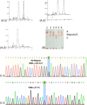 (A.1) Hb-HPLC of the infant showing unknown Hb with the same retention time of HbA2. (A.2) Hb-HPLC of the father showing Hb unknown Hb with the same retention time of HbA2. (A.3) Hb-HPLC of the mother showing normal profile; (B) Electrophoresis of hemoglobins at pH 8.0. 1: Hb A (mother); 2: Hb AS; 3: Hb A/Maputo (infant); 4: Hb SC; 5: Hb AS; 6: Hb A/Maputo (father). (C) Electropherogram of the globin gene: (C.1) Sequencing of the beta-globin gene revealed a mutation in the codon 47 (β47 Asp>Tyr-HBB: c.142G>T) in heterozygosis corresponding to Hb Maputo, (C.2) Sequencing of the beta-globin gene revealed a mutation in the codon 2 (β2 His>His; HBB: c.9T>C) in heterozygosis, a silent variant.