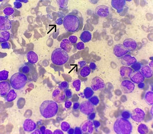 Presence of Plasmodium vivax gametocytes in a bone marrow aspirate.
