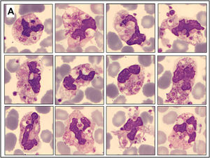 Peripheral blood smear from the EDTA sample showing multiple neutrophils containing intracytoplasmic platelets, with rare platelet satellitism. May-Grünwald-Giemsa stain; original magnification × 1000 (oil immersion).