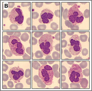 Peripheral blood smear from a sodium citrate sample obtained immediately afterward showing complete disappearance of intracytoplasmic platelets and only rare residual platelet satellitism, confirming EDTA-dependent pseudothrombocytopenia. May-Grünwald-Giemsa stain; original magnification × 1000 (oil immersion).