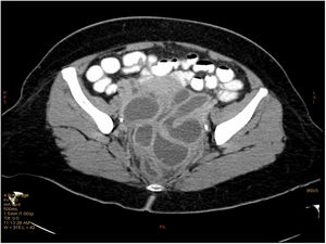 Abdominal CT showing tubo-ovarial abscesses.