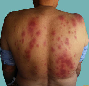 Lesiones clínicas. Placas eritematovioláceas y edematosas confluyentes en hombros, región escapular y zona lumbar.