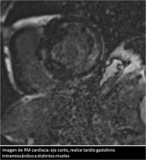 Imagen de RM cardiaca: eje corto con realce tardío de gadolinio a diferentes niveles.