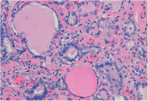 The epithelium in many of the follicles is degenerated or partially denuded, with vacuolated cytoplasm and pyknotic nuclei. Aggregates of foamy histiocytes within the injured follicles (H/E).