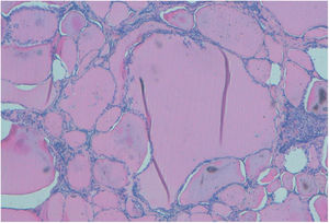 There are follicles enlarged with flattened surface epithelium, and some macrophage into the parenchyma (H/E).