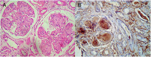 A) Expansión mesangial con nódulos hialinos acelulares (esclerosis nodular). B) Inmunohistoquímica kappa positivo 3+, lambda+/− y CD34 positivo.