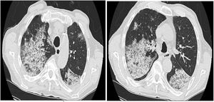 TC de tórax. Áreas parcheadas de aumento de densidad en vidrio deslustrado con engrosamiento de septos interlobulillares (crazy paving), que afecta a ambos parénquimas pulmonares, de predominio en segmentos apicales y posterior del LSD y segmentos superiores de ambos lóbulos inferiores.