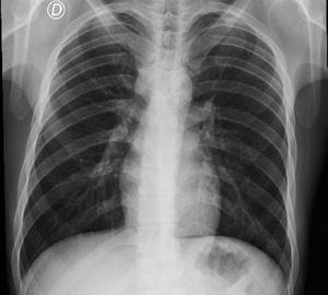 Posteroanterior chest X-ray after 72h of conservative management with the disappearance of soft tissue air.